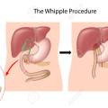 Patient’s Guide to the Whipple Procedure